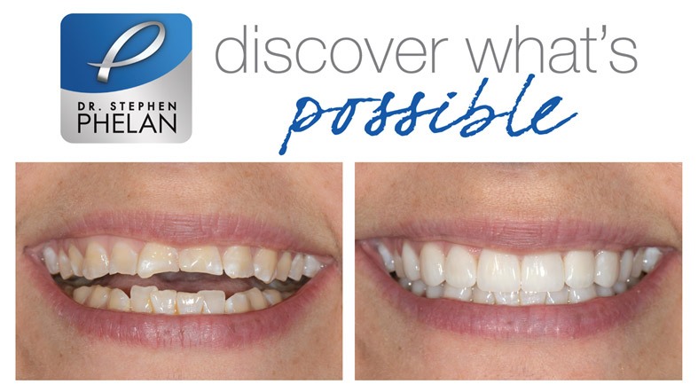 Before and After Results Teeth Transformation 3